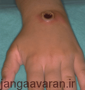 anthraxlesion